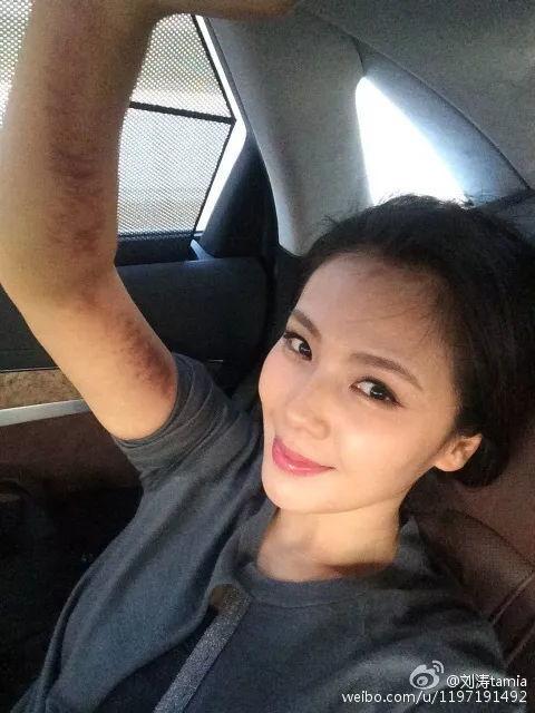 孙俪刮痧照片,展现健康生活新风尚